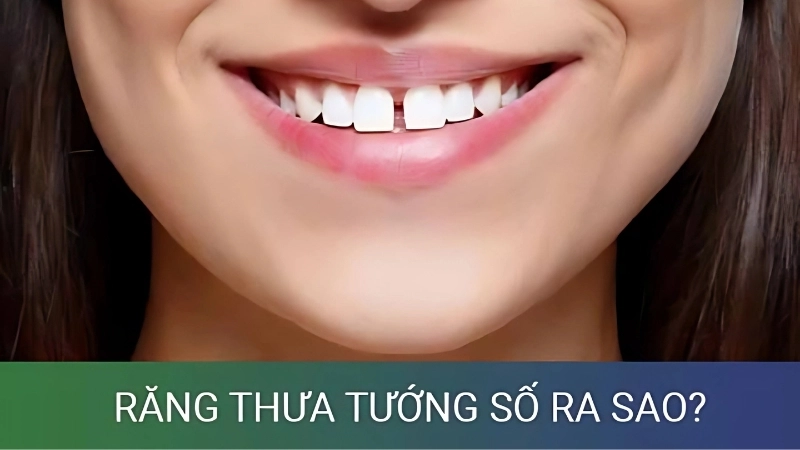 Tướng răng thưa là gì và ý nghĩa trong nhân tướng học